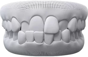 invisalign for crossbite