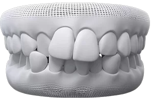 invisalign for crowded teeth