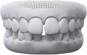 invisalign for gaps