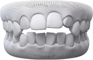 invisalign for open bite