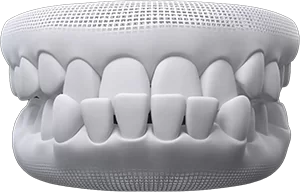invisalign for underbite